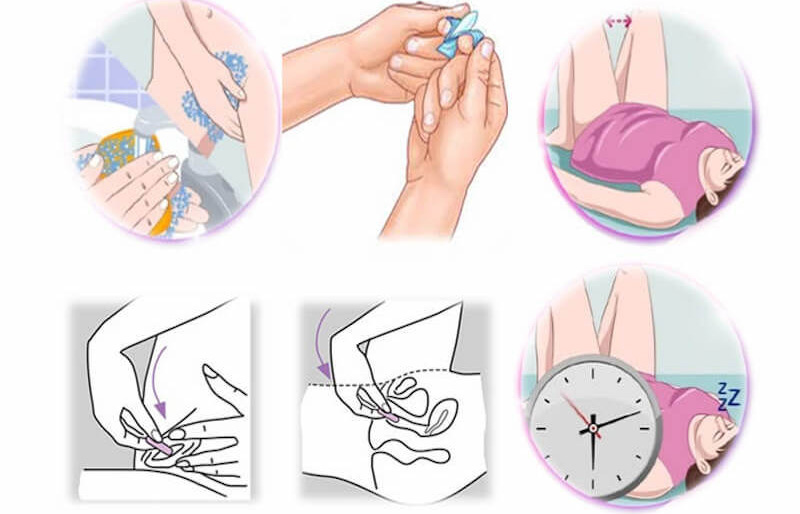 Hướng dẫn cách đặt thuốc vùng kín an toàn, đúng cách