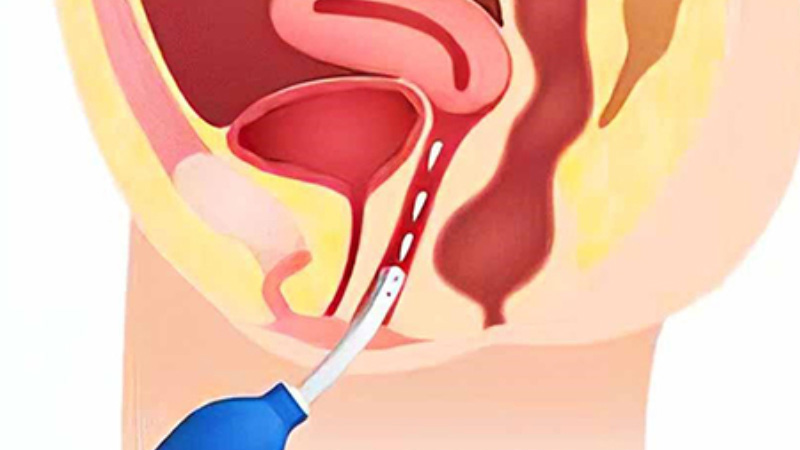 Có nên thụt rửa vùng kín bằng nước muối?