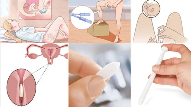 Công dụng và cách đặt viên đặt se khít âm đạo