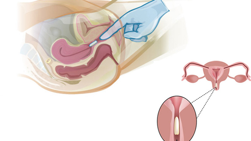 Công dụng và cách đặt viên đặt se khít âm đạo