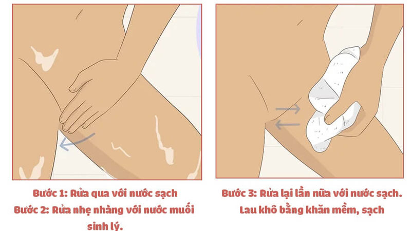 Cách vệ sinh vùng kín sau sinh mổ an toàn và sạch sẽ