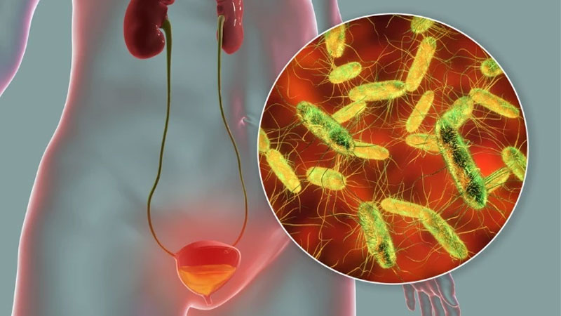 Nguyên nhân đi vệ sinh bị rát vùng kín và cách xử lý