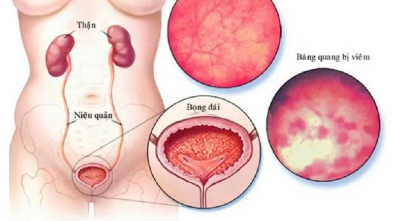 Nguyên nhân đi vệ sinh bị rát vùng kín và cách xử lý