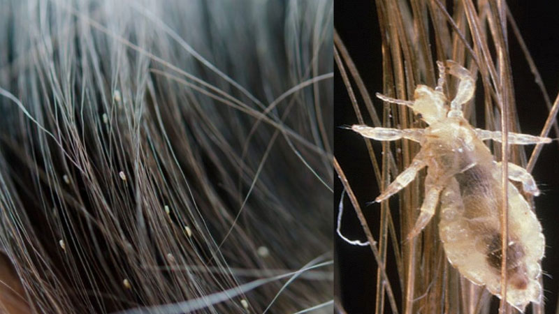 Gợi ý 8 loại thuốc và dầu gội trị chấy cho bé an toàn, hiệu quả nhanh