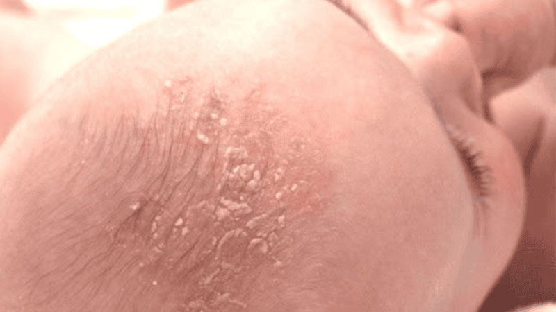 TOP 5 dầu gội trị cứt trâu cho bé hiệu quả tốt nhất hiện nay