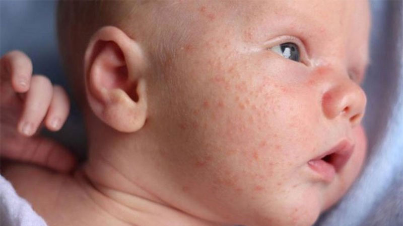 Đánh giá chi tiết sữa tắm Lactacyd trị rôm sảy cho bé