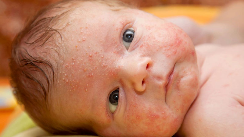 Cách nấu nước tắm mướp đắng trị rôm sảy cho bé