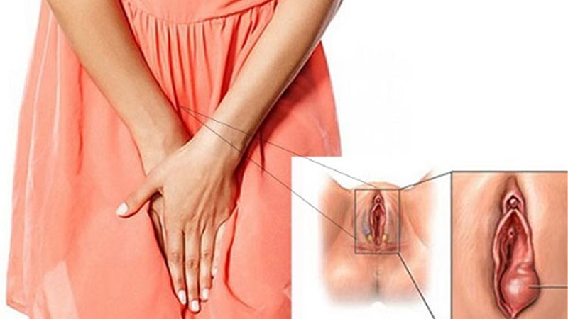 Nguyên nhân quan hệ xong bị sưng vùng kín và cách xử lý