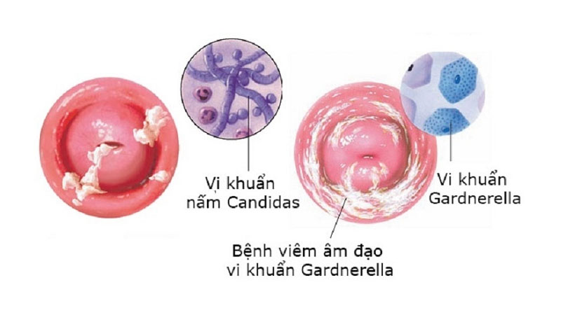 Vì sao quan hệ xong ra dịch trắng? Có nguy hiểm không?