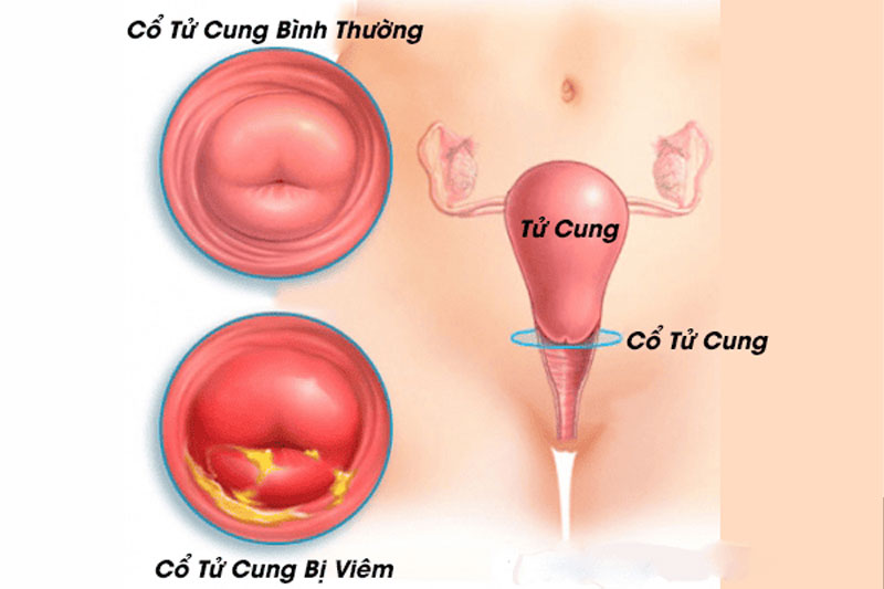 Vì sao quan hệ xong ra dịch trắng? Có nguy hiểm không?