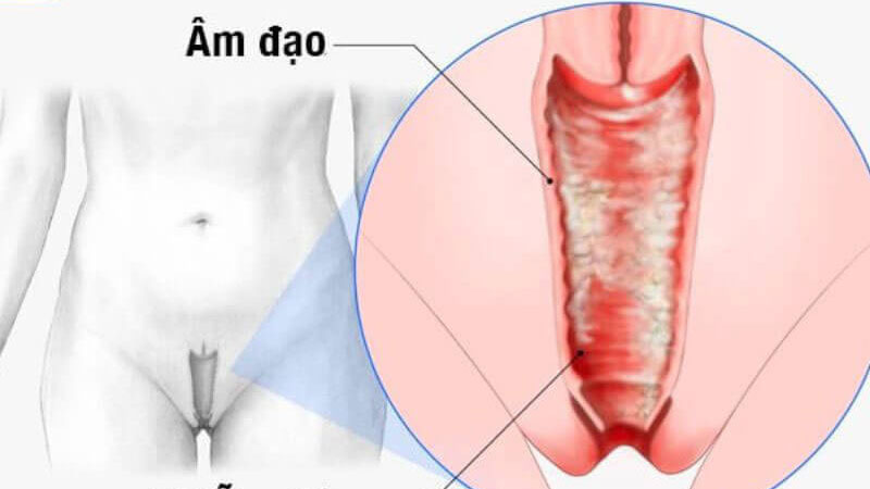 Quan hệ xong ra dịch vàng, xanh có nguy hiểm không?