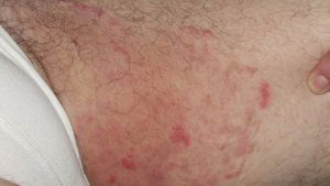 Sau khi cạo lông vùng kín, một số người có thể gặp tình trạng ngứa ngáy